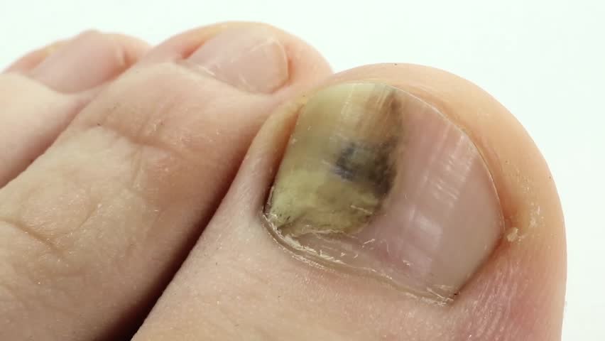 trauma-of-toenail-subungual-hematoma-bruise-under-the-nail-of-big-toe