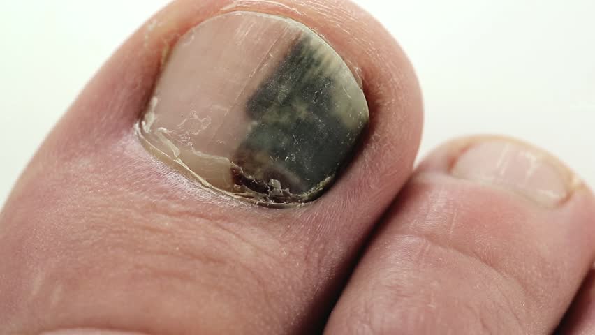 Subungual Hematoma. Bruise Under The Nail Of Big Toe. Injury To The ...