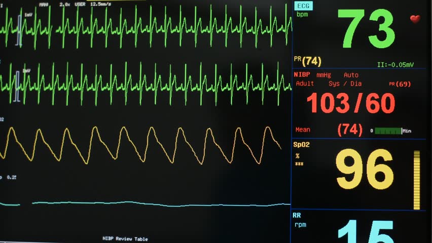 vital-signs-monitor-during-surgery-stock-footage-video-1900345