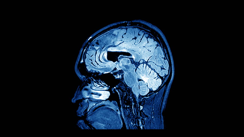 MRI Brain Scan Stock Footage Video 7989748 - Shutterstock