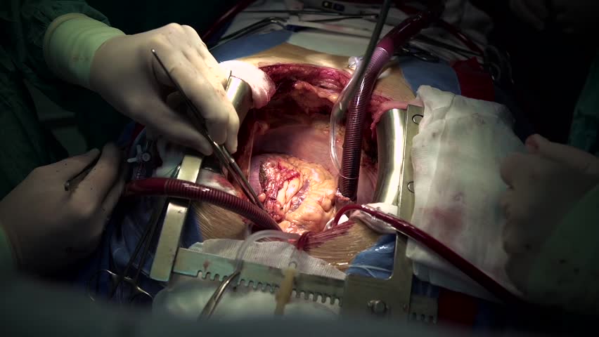 Image result for open heart surgery