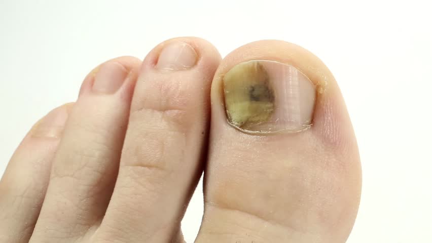 Injury Under Toenail