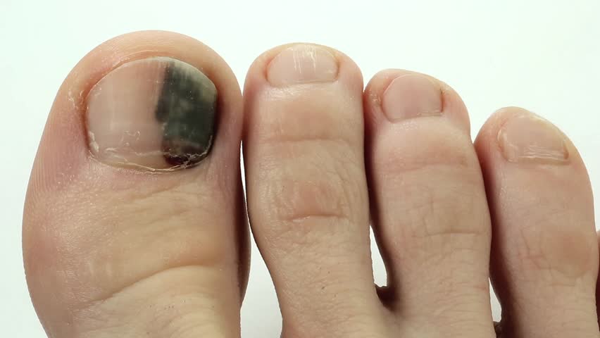 Subungual Hematoma. Bruise Under The Nail Of Big Toe. Injury To The ...