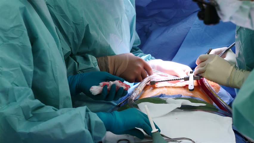 Open Heart Surgery Stock Footage Video - Shutterstock