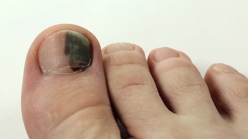 Subungual Hematoma Bruise Under The Nail Of Big Toe Injury To The